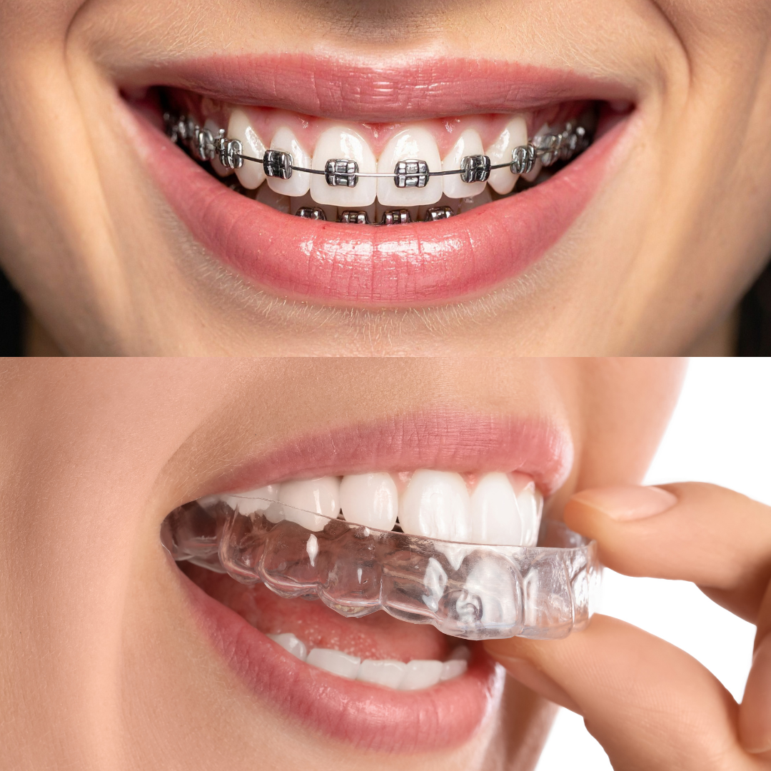 Braces and Aligners