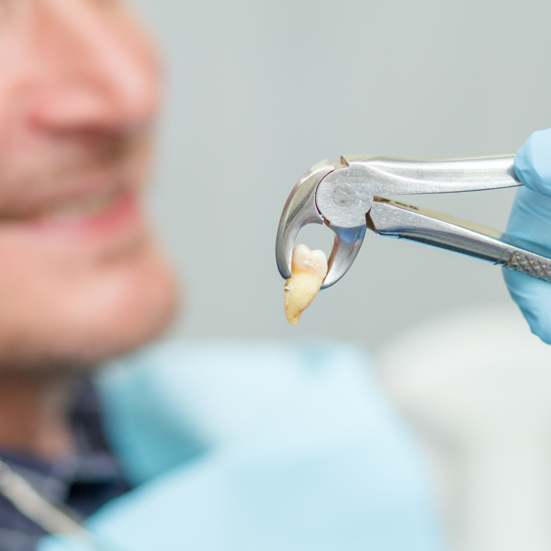 Teeth Extraction