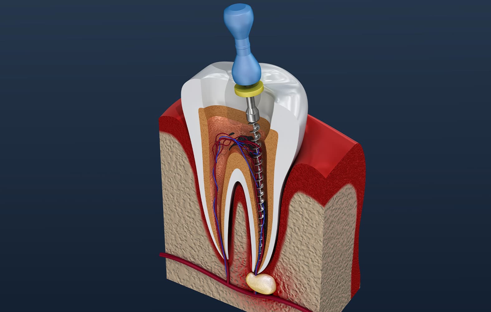 Root Canal