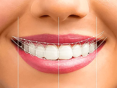 Smile Designing